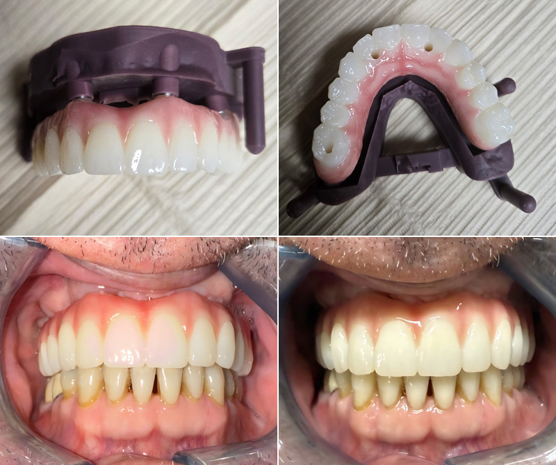 Implants in Chandler