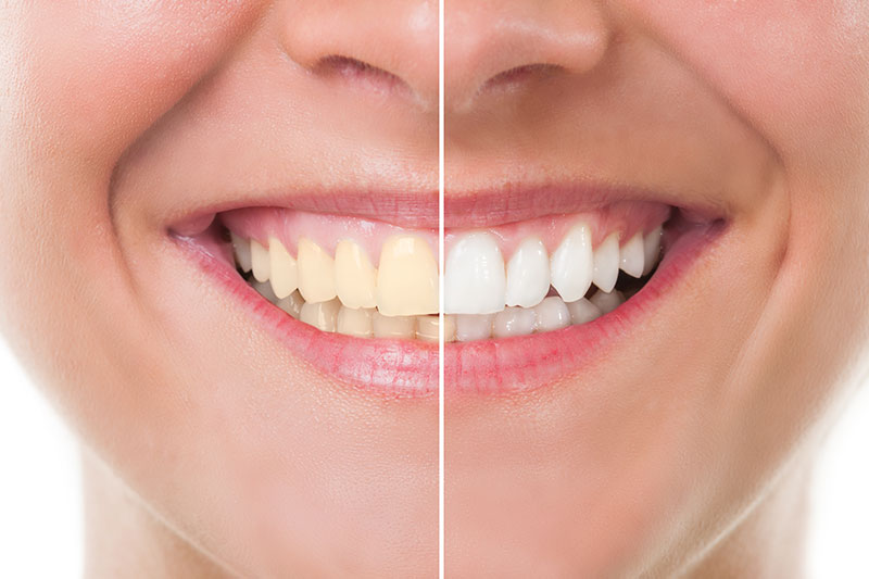 Teeth Whitening in Chandler